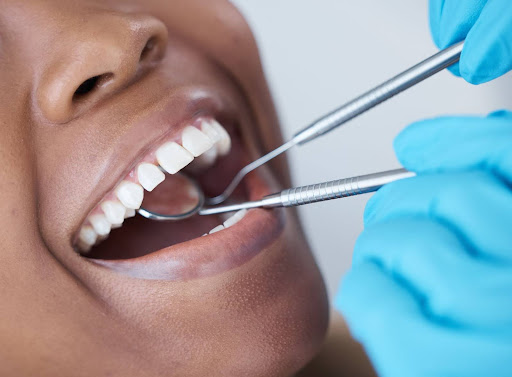 Close-up of a woman�s mouth during a dental checkup, with a mirror inspecting teeth for cavities